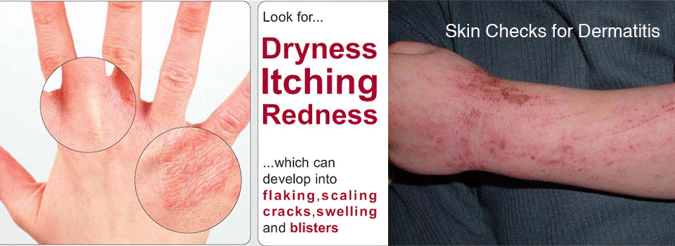 skin-checks-for-Dermatitis